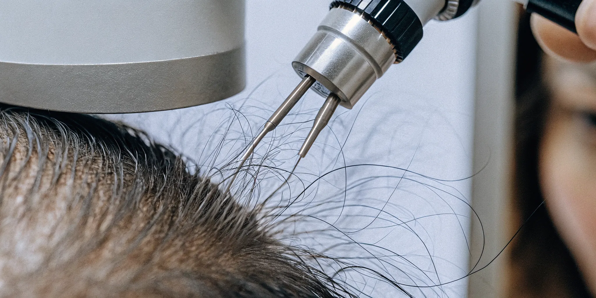 High-definition digital scalp analysis at The Sage HeadSpa using trichology camera