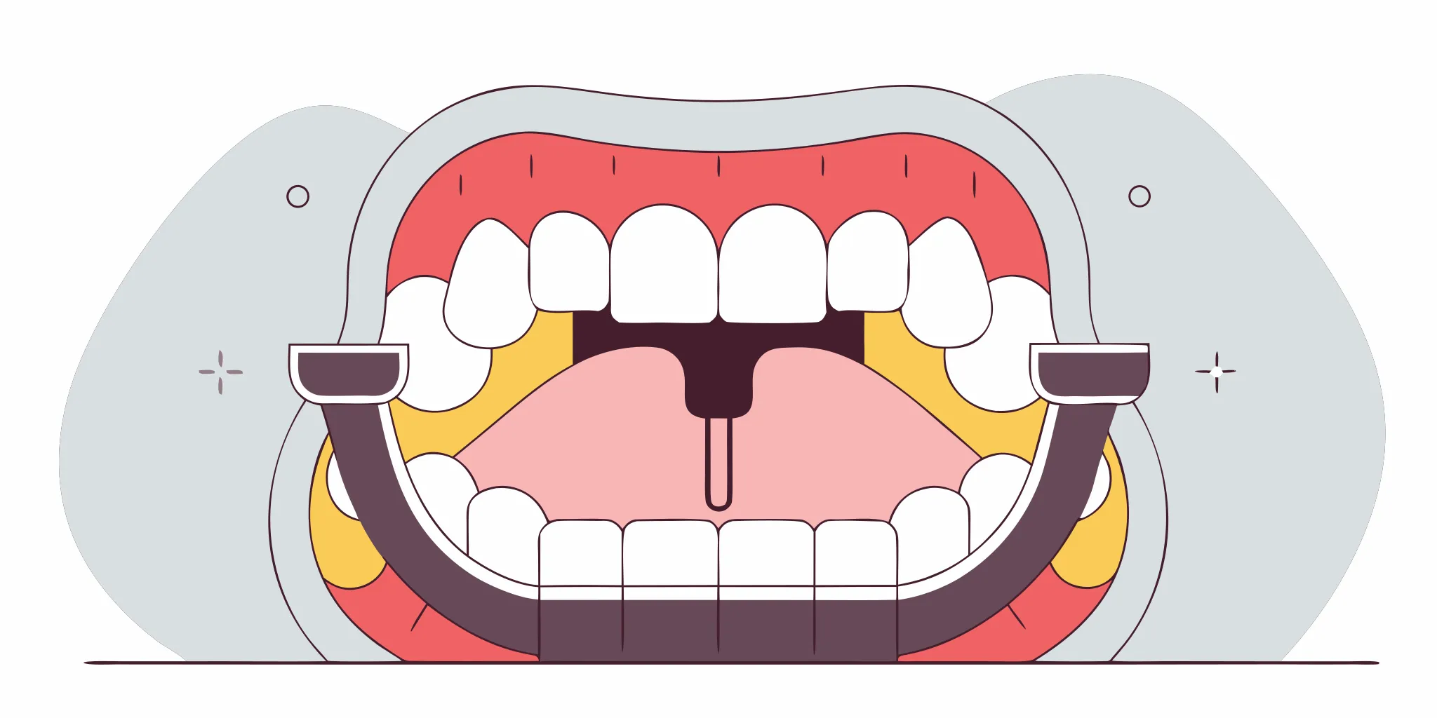 Custom-fitted oral appliance device for sleep apnea treatment on medical background
