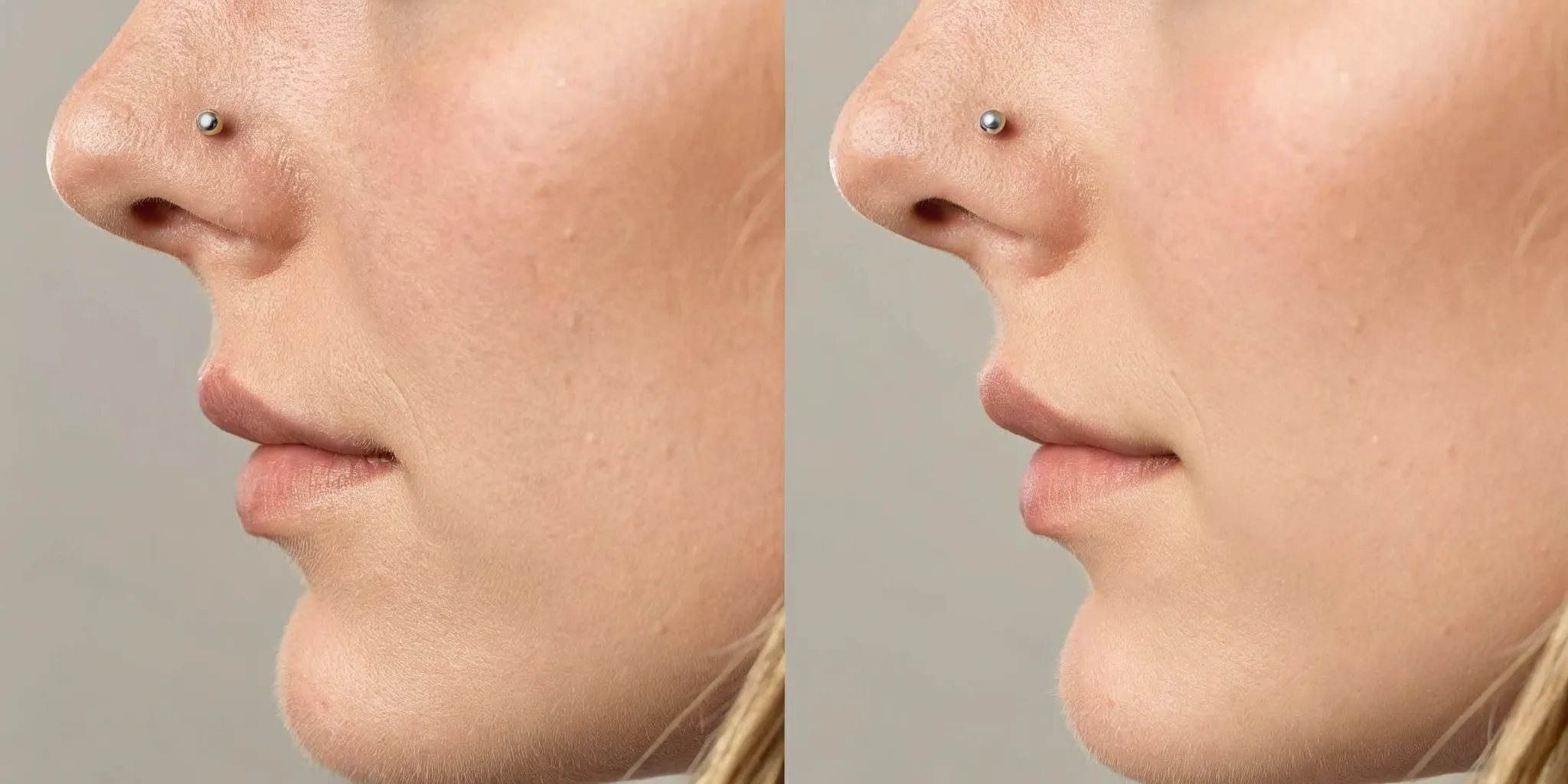 Healed nostril piercing with a small titanium stud