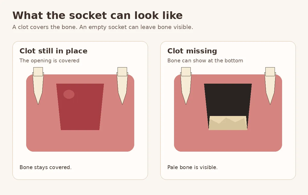 Diagram comparing a clot-covered extraction socket with an empty socket where pale bone is visible at the base
