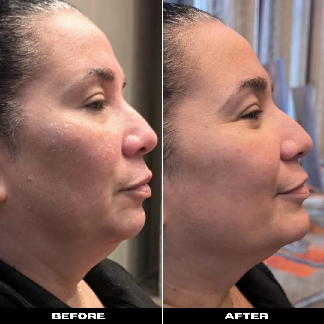 Microneedling treatment planning for acne scars at Soul Glow Medspa