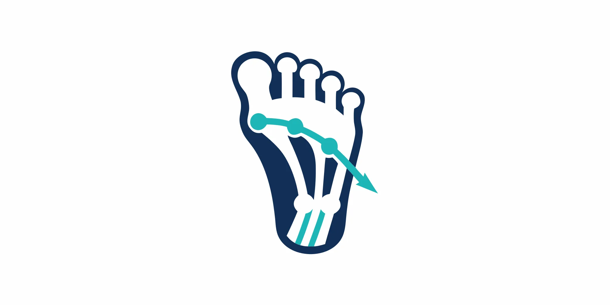 Medical diagram showing bunion anatomy with big toe joint misalignment and the characteristic bony bump on the side of the foot