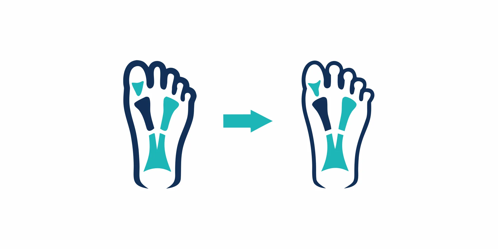 Before and after comparison illustration showing bunion deformity correction through foot surgery