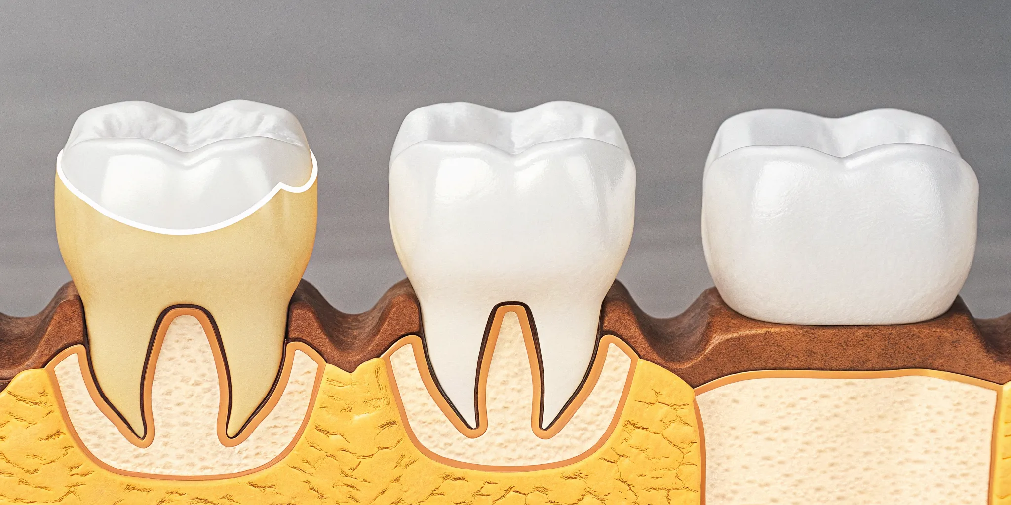 Stages of dental crown treatment from damaged tooth to fitted crown