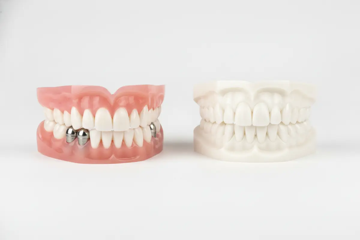 Diagram-style view of a removable implant overdenture beside a fixed full-arch prosthesis