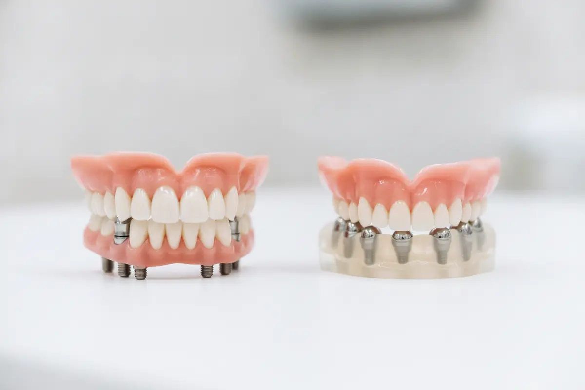 Fixed full-arch implant bridge and removable implant-supported denture shown side by side