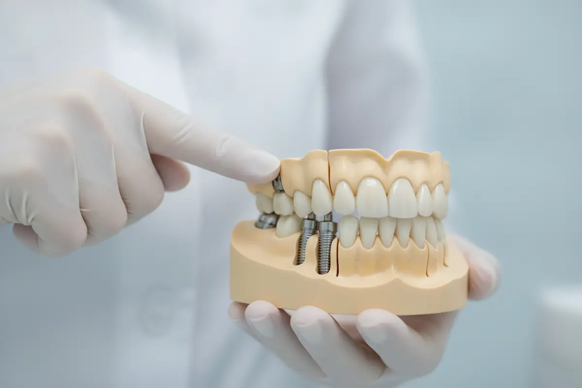 Illustration of a fixed full-arch prosthesis supported by dental implants