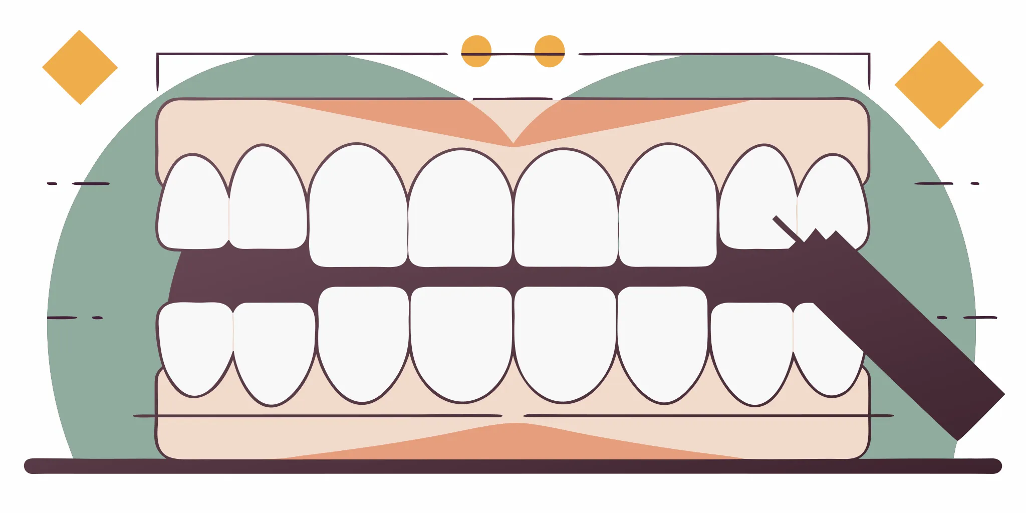 Close-up of a rounded chamfer crown prep margin design on a prepared molar