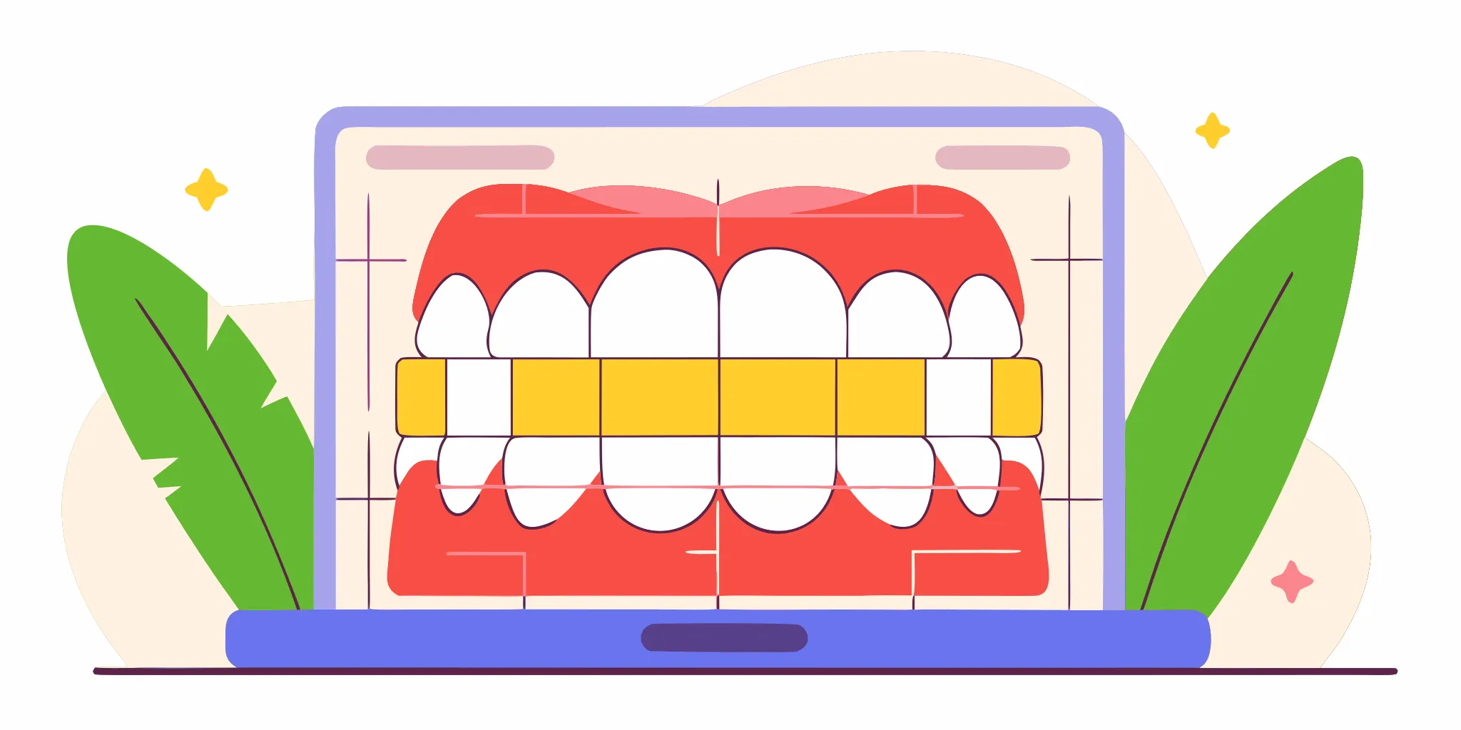 High-resolution digital dental scanning workflow diagram showing the optimal scanning path to capture precise interproximal details.