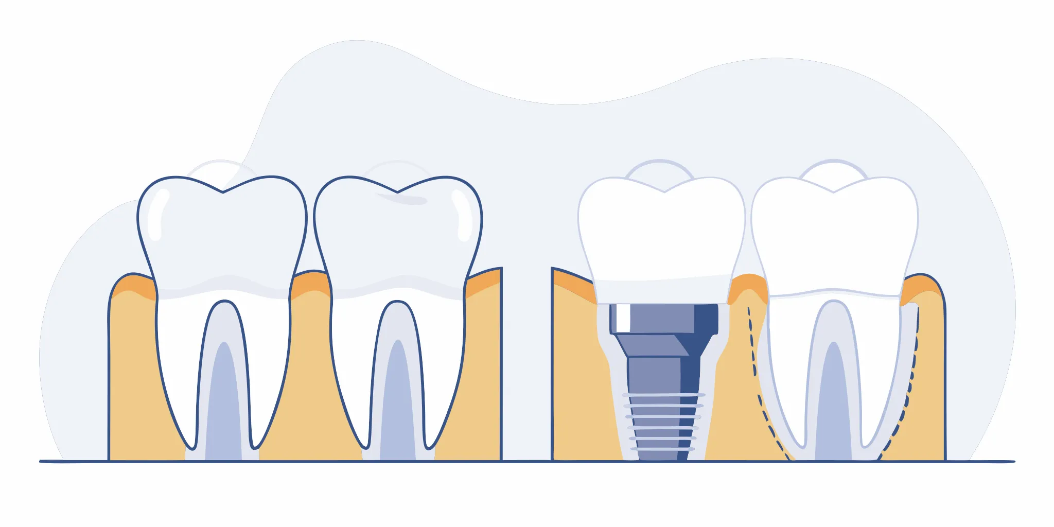 Cross-section comparing titanium and zirconia custom dental implant abutments