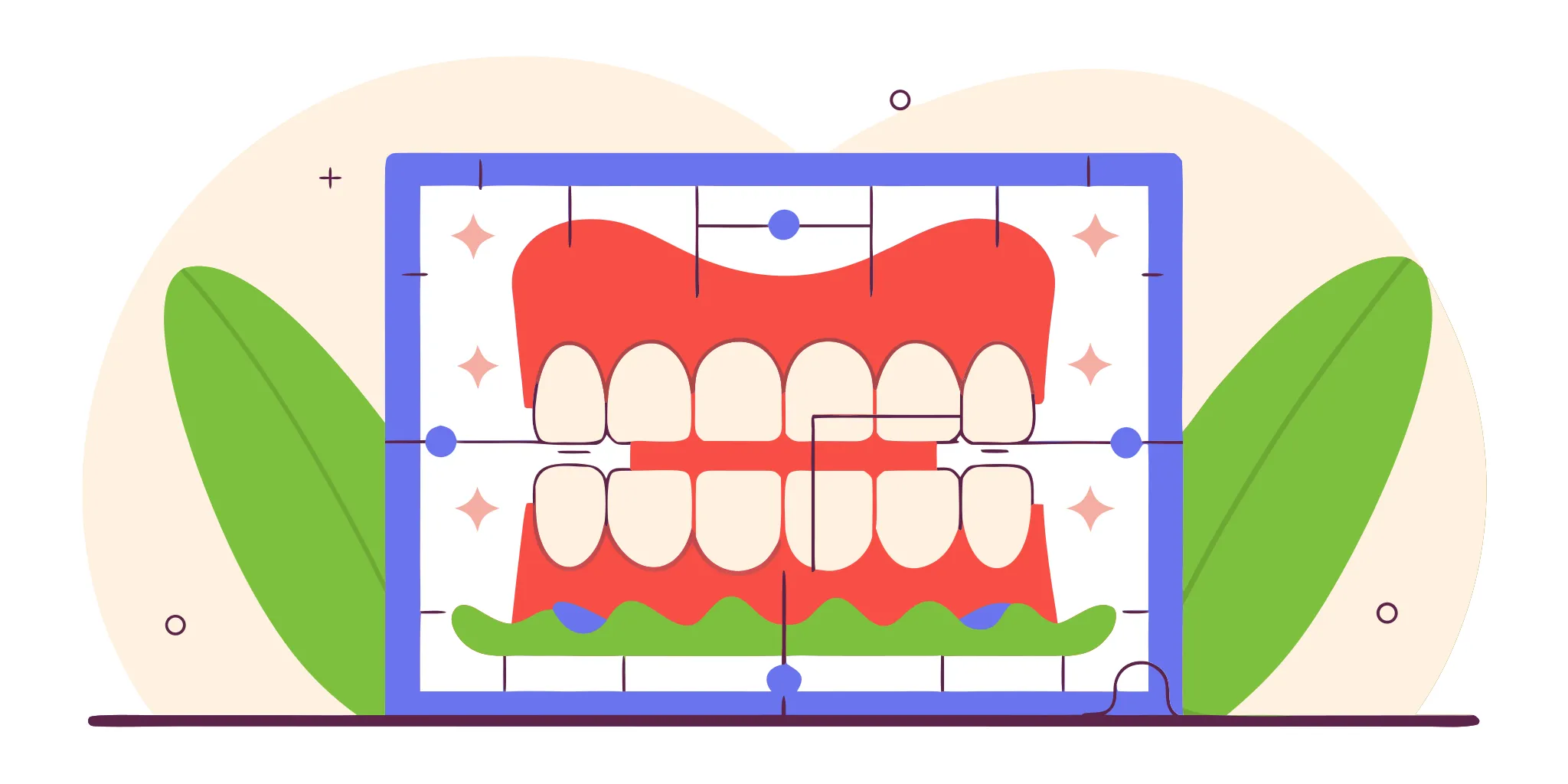 Intraoral digital scan showing crown prep margin design finish lines highlighted in green