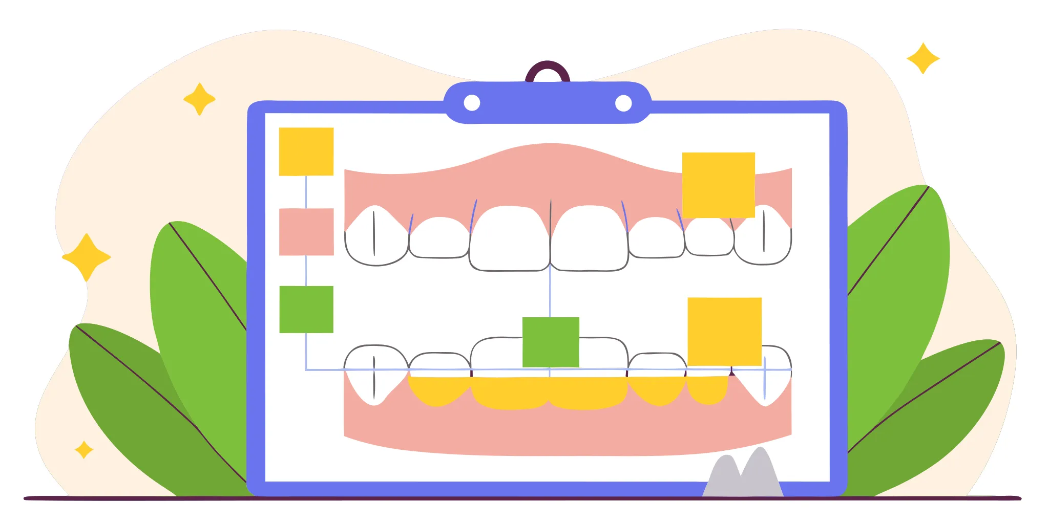Digital orthodontic planning software visualization of interproximal reduction (IPR) planning and attachment placement for controlled tooth movement.