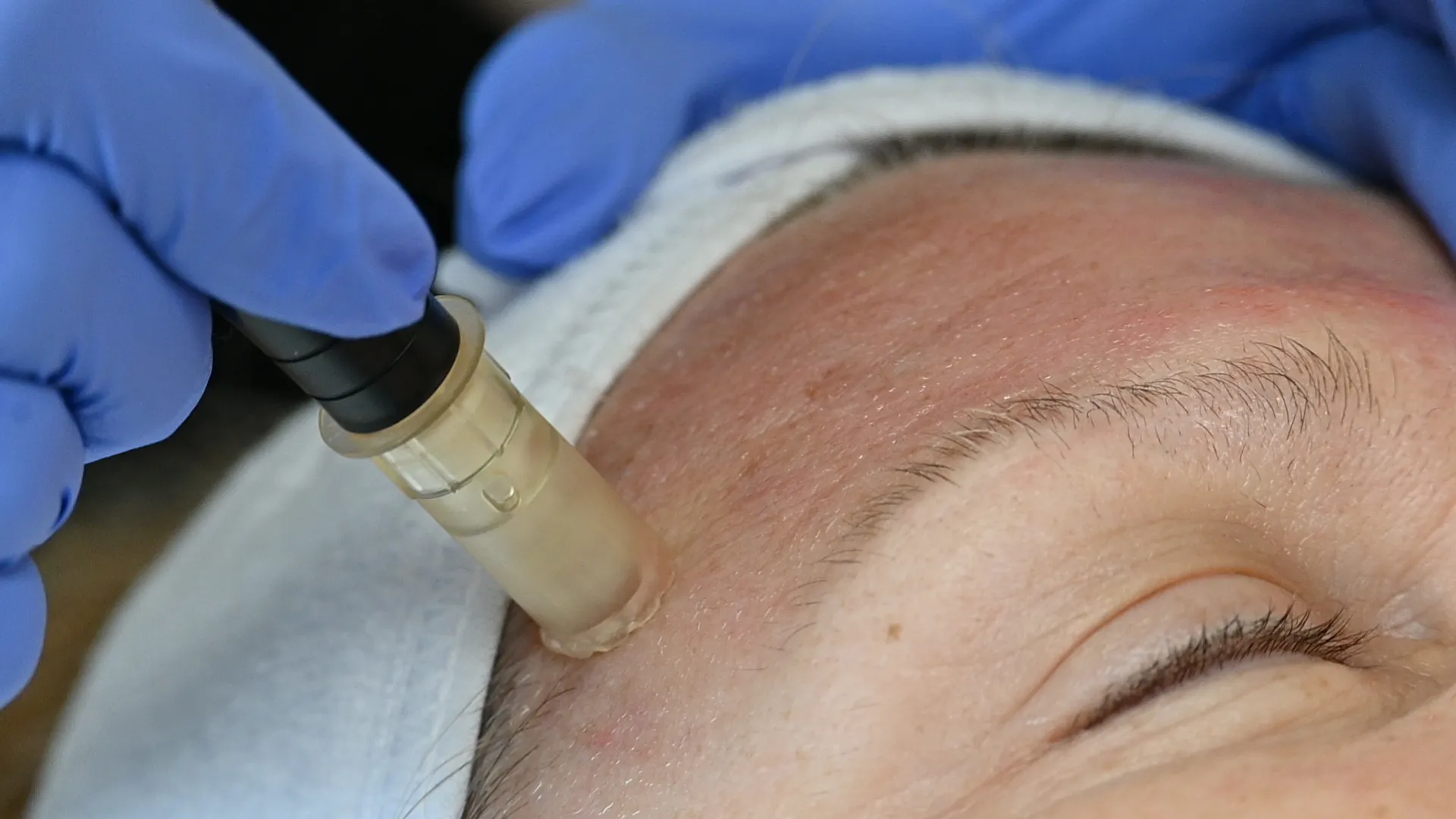 ghk-cu microneedling protocol Peptide Dosage: Complete Guide for Skin, Hair, and Healing Goals GHK-Cu for Hair Growth: Protocols