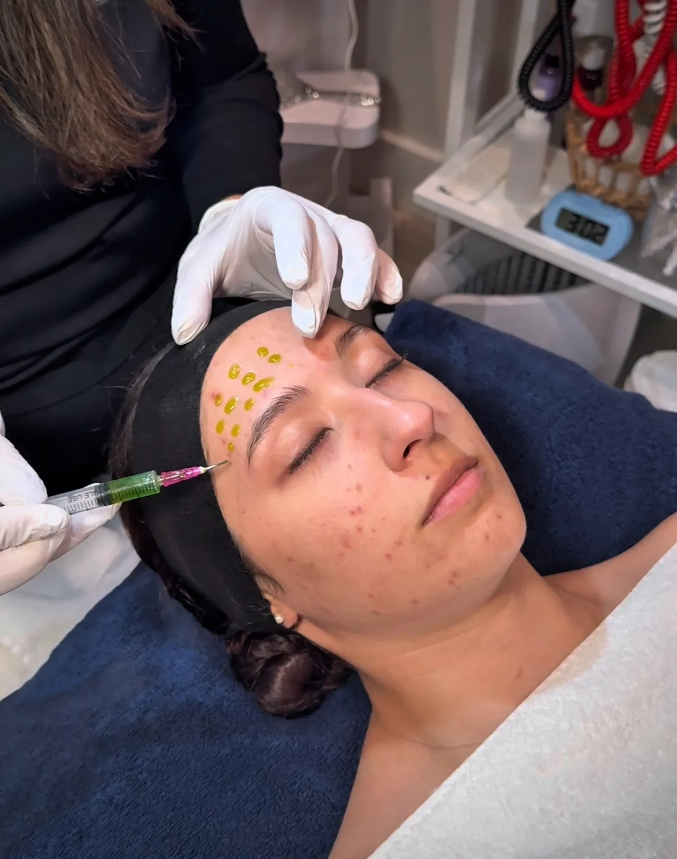 OC Skin Care Center microneedling treatment in Orange County