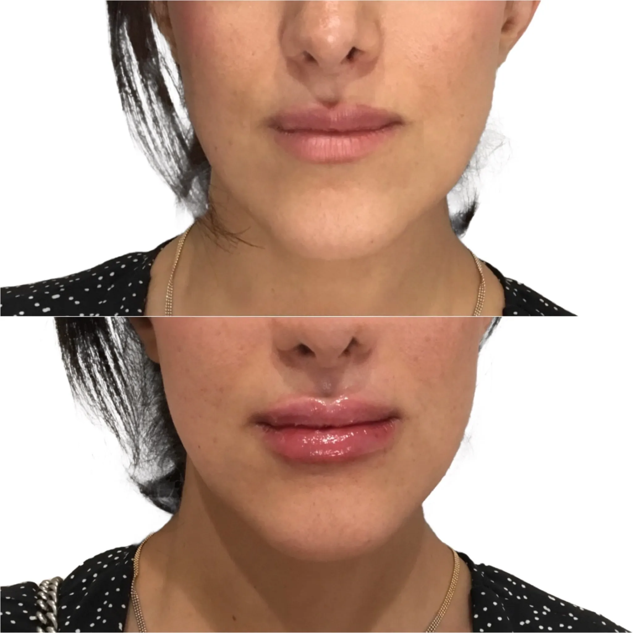 Dermal filler treatment area example at OC Skin Care Center