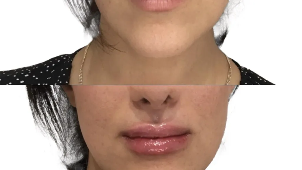 Subtle lip filler comparison showing natural-looking lip definition and volume