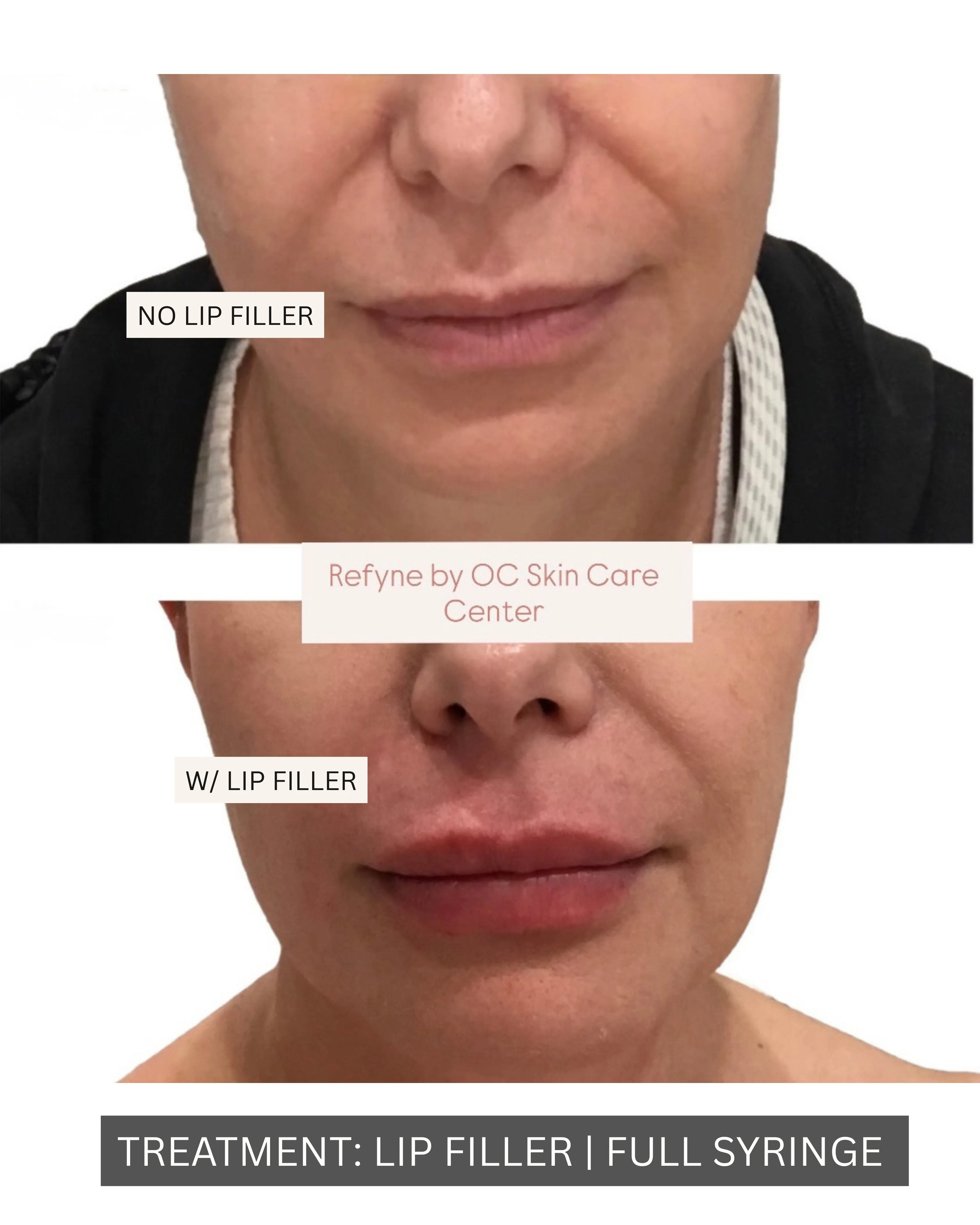 Lip filler before-and-after result at OC Skin Care Center