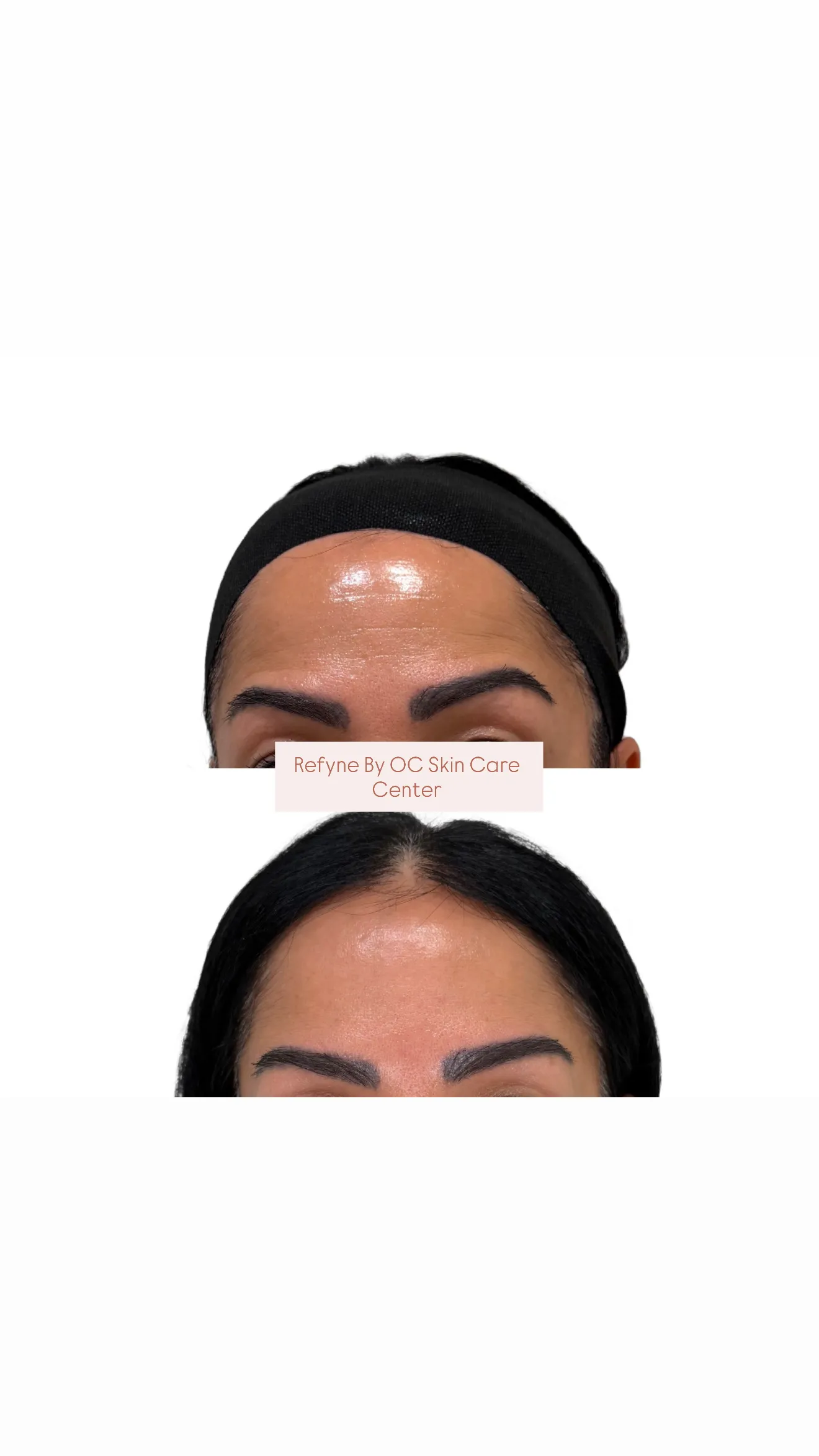 OC Skin Care Center Dysport and Botox treatment image