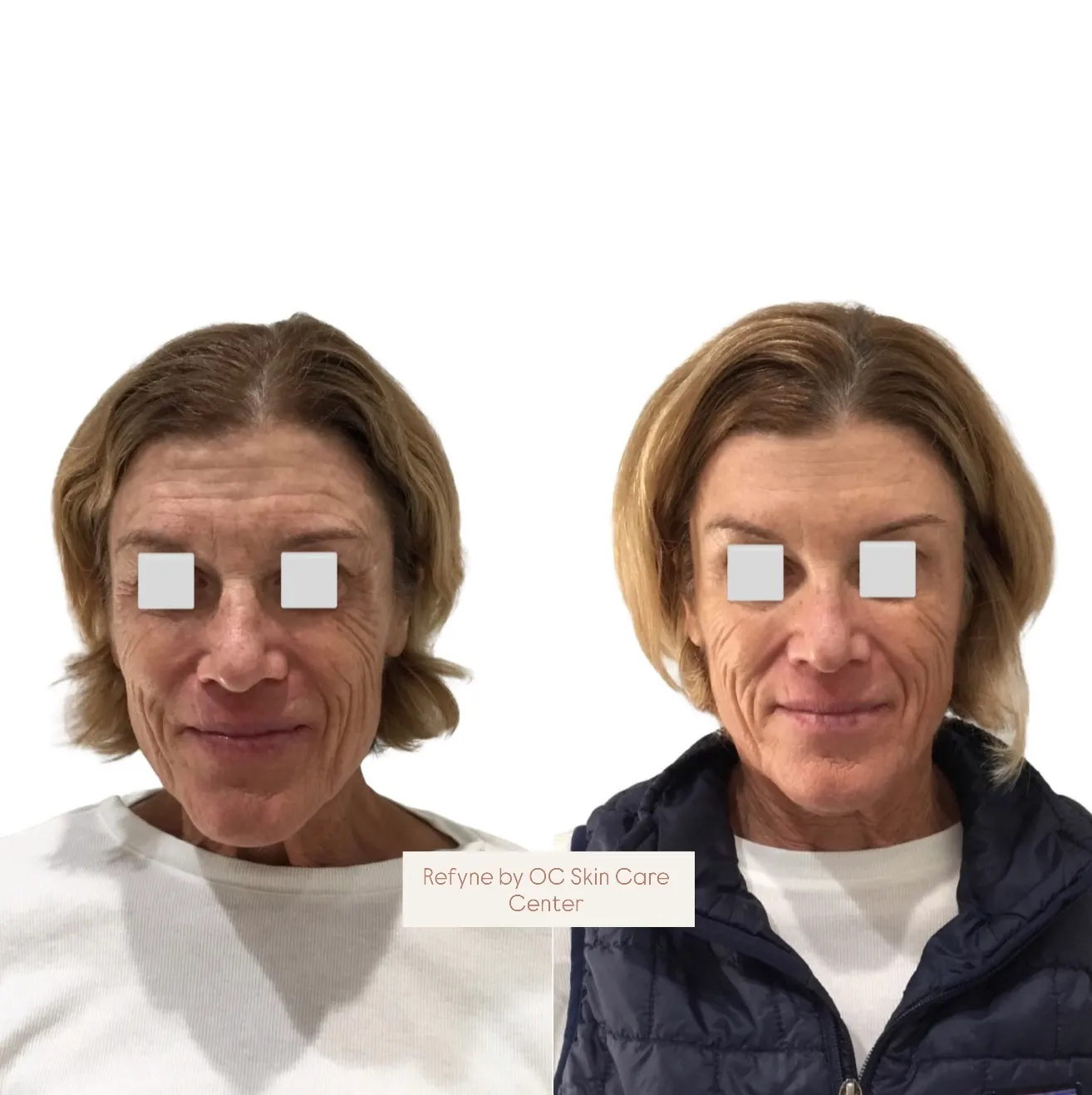 OCSC client before-and-after skin rejuvenation results